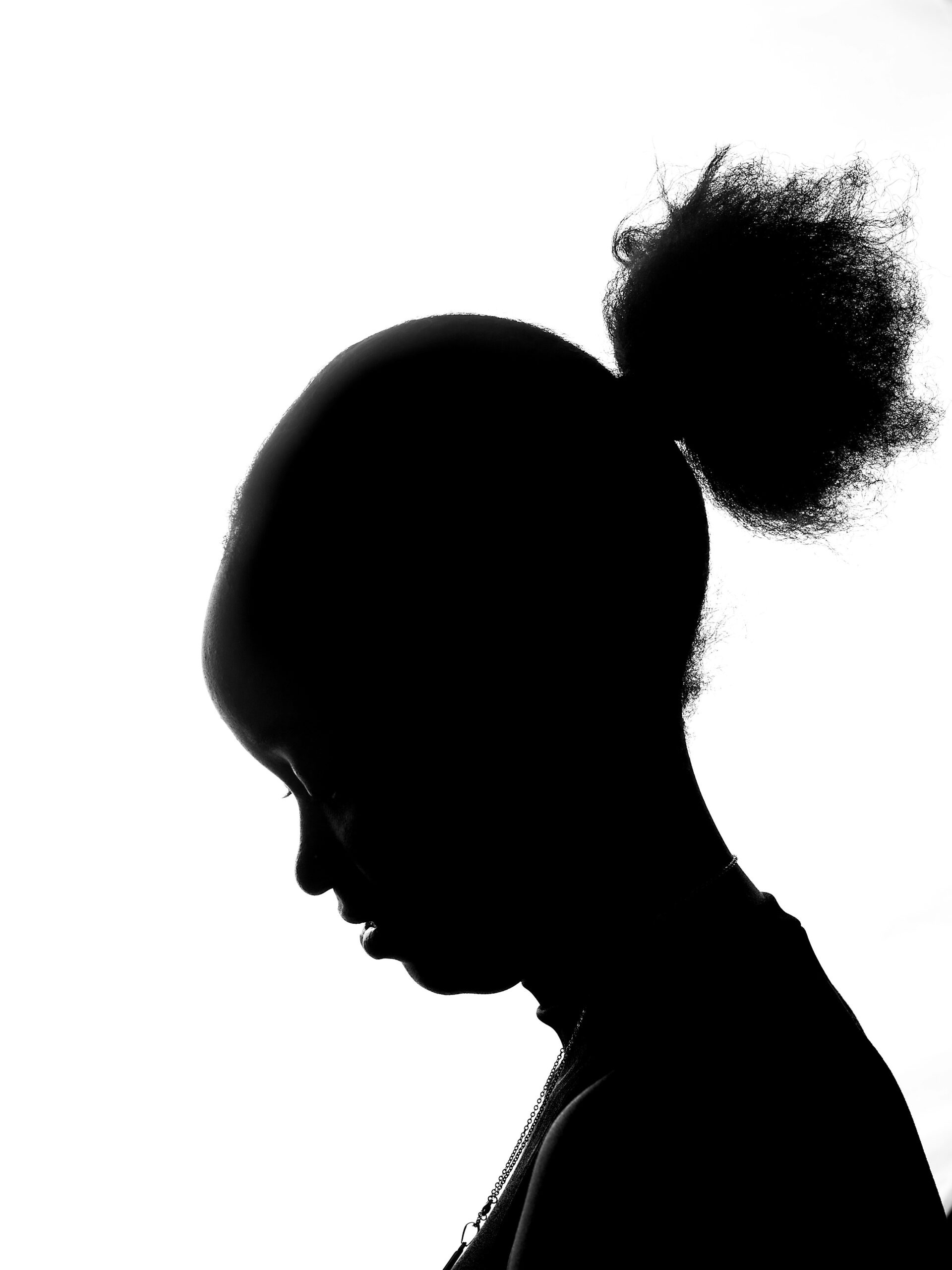 Siyah Kadınlarda Santrifüj Sikatrisyel Alopesi: Yanlış Teşhis Nedenleri