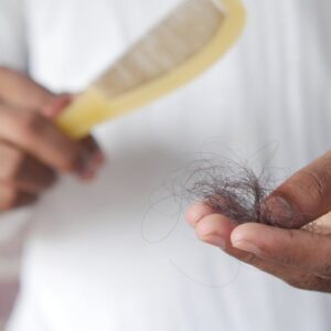 Saç Dökülmesi: Androjenik Alopesi (Erkek Tipi Kellik) Nedenleri ve Tedavisi